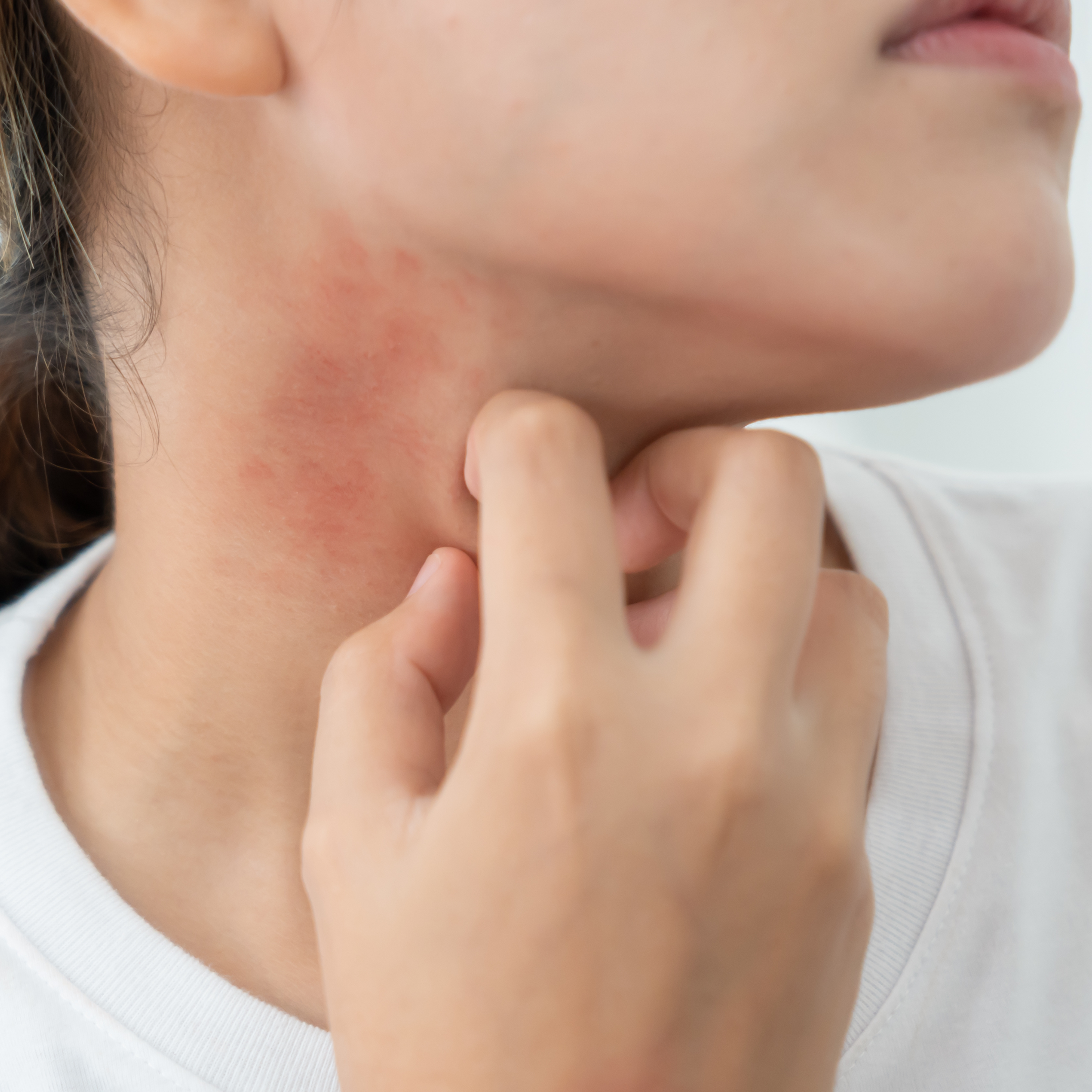 Skóra podrażniona, reaktywna i atopowa