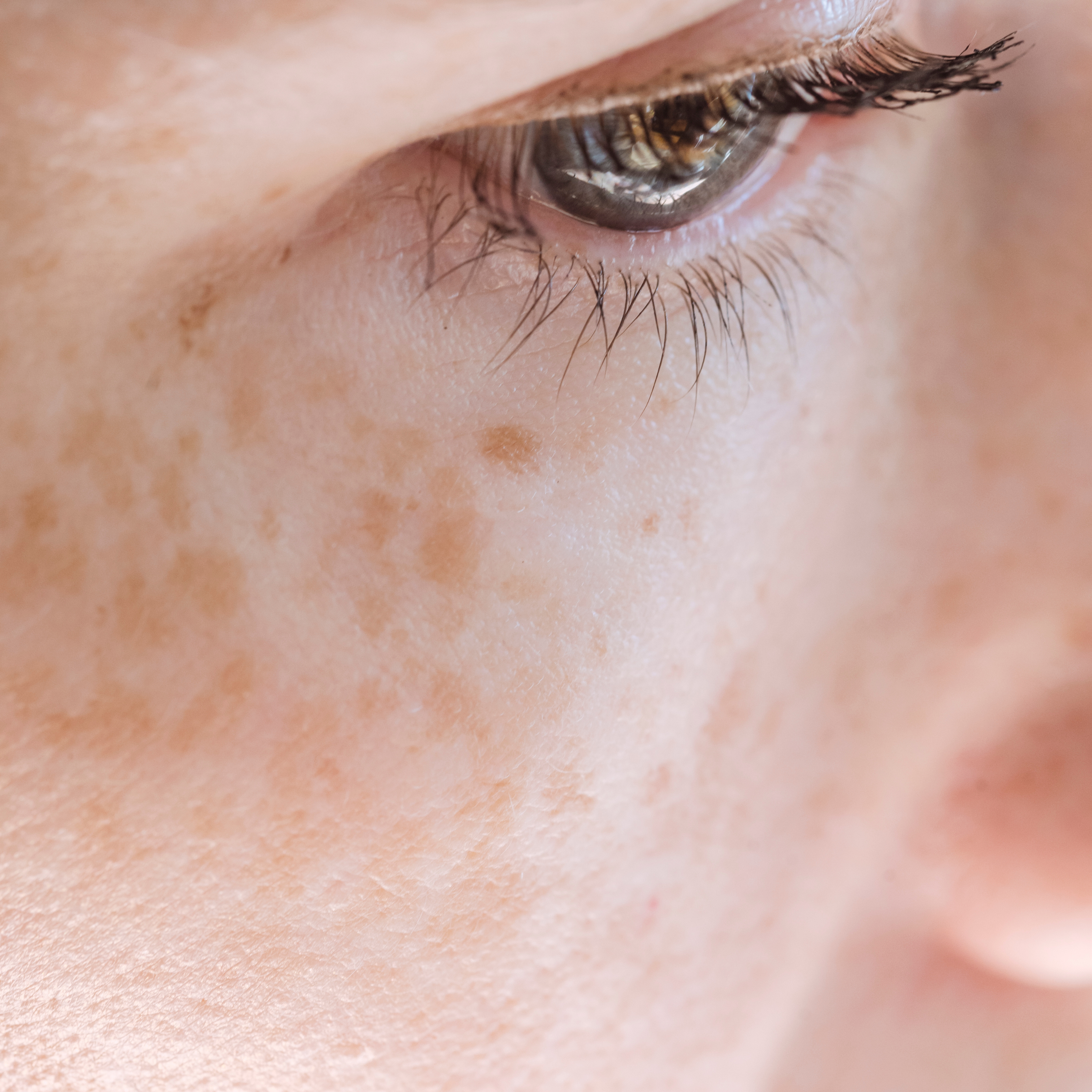 Przebarwienia i naczynka